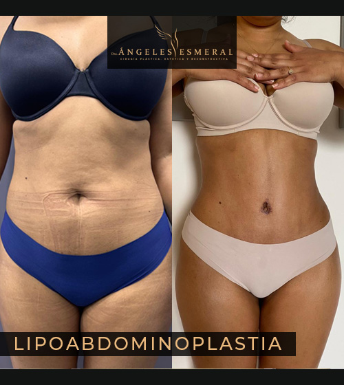 Lipoabdominoplastia Antes y Después Dra Angeles Esmeral imagen 3