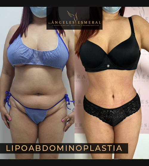 Lipoabdominoplastia Antes y Después Dra Angeles Esmeral imagen 2