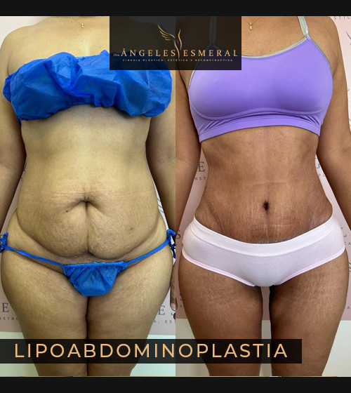 Lipoabdominoplastia Antes y Después Dra Angeles Esmeral imagen 1