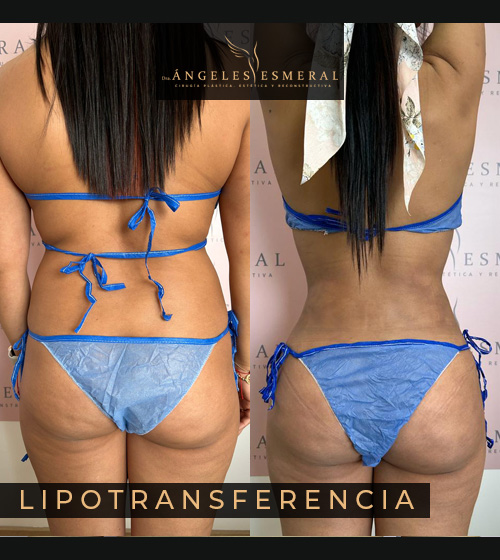 Lipotransferencia Antes y Después Dra Angeles Esmeral