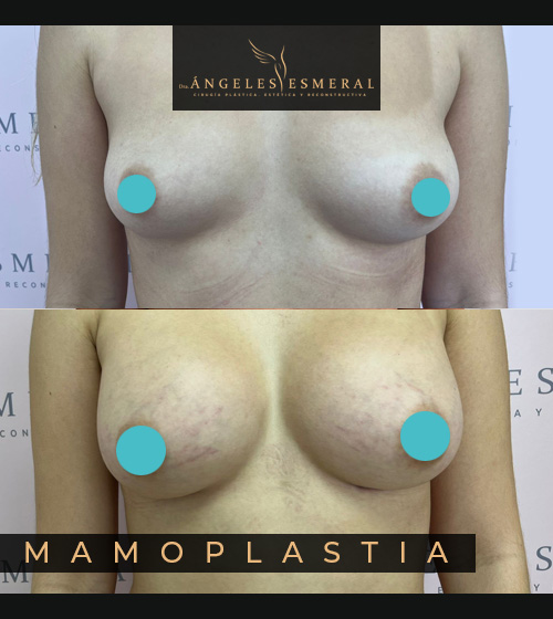 Mamoplastia Antes y Después Dra Angeles Esmeral imagen 3