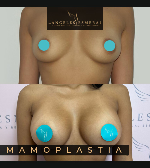 Mamoplastia Antes y Después Dra Angeles Esmeral imagen 1