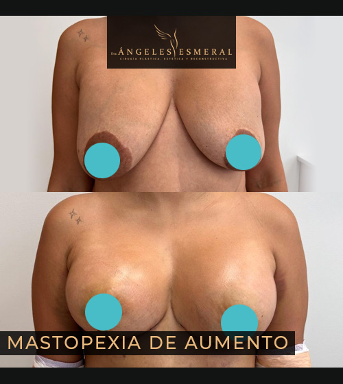 Mastopexia de Aumento Antes y Después Dra Angeles Esmeral