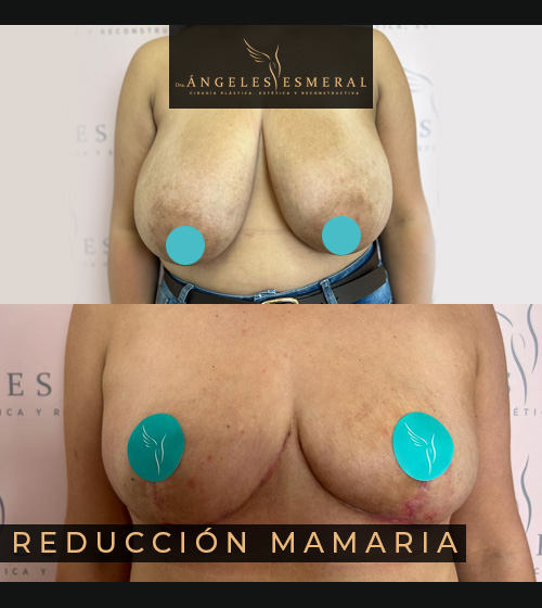 Reducción Mamaria Antes y Después Dra Angeles Esmeral imagen 2