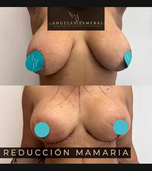 Reducción Mamaria Antes y Después Dra Angeles Esmeral imagen 1