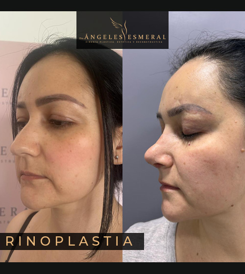 Rinoplastia Antes y Después Dra Angeles Esmeral